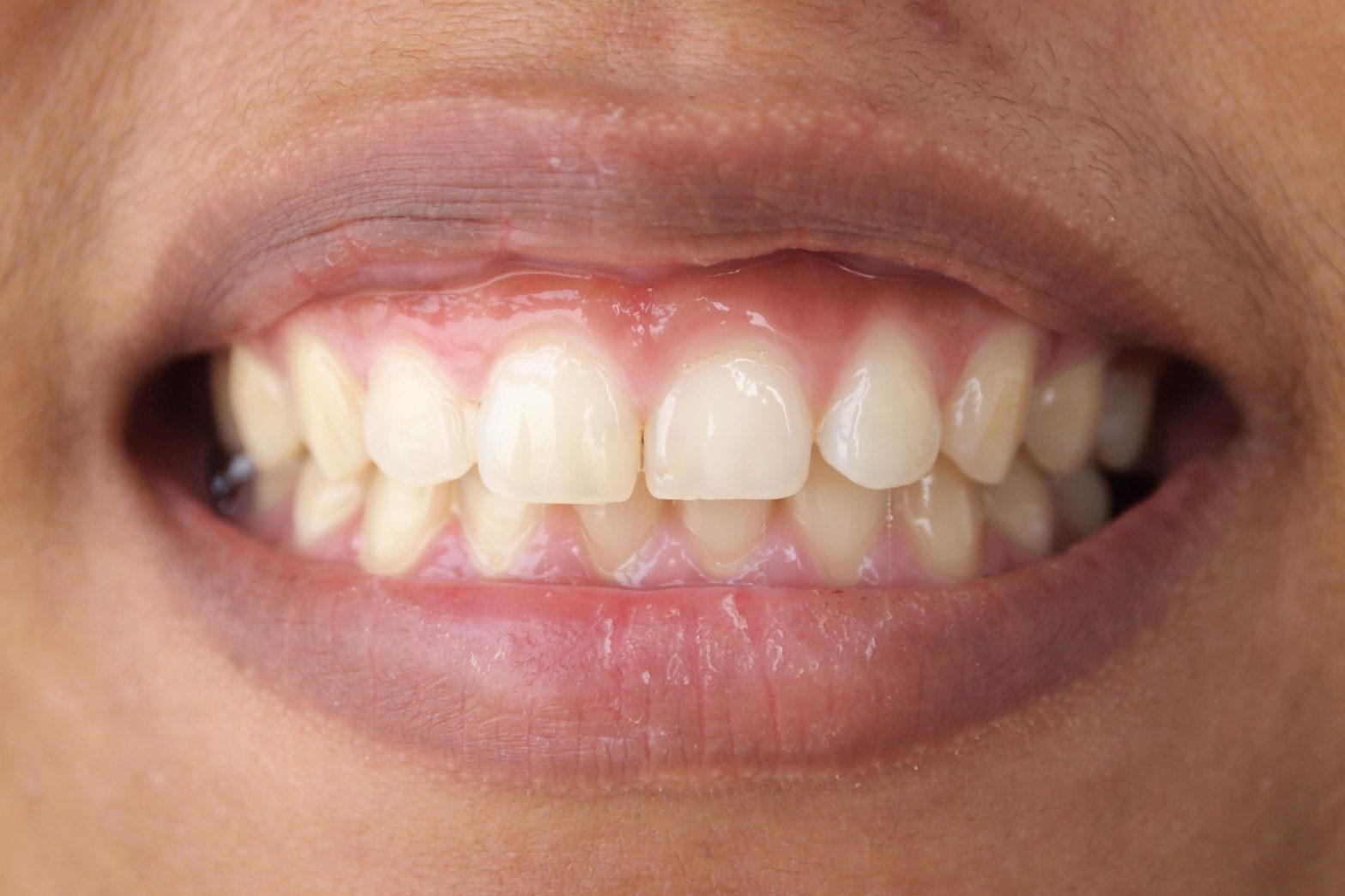 Gum Contouring