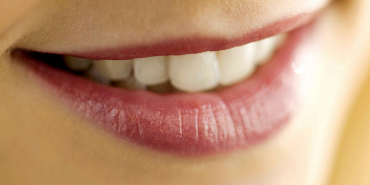 Veneers