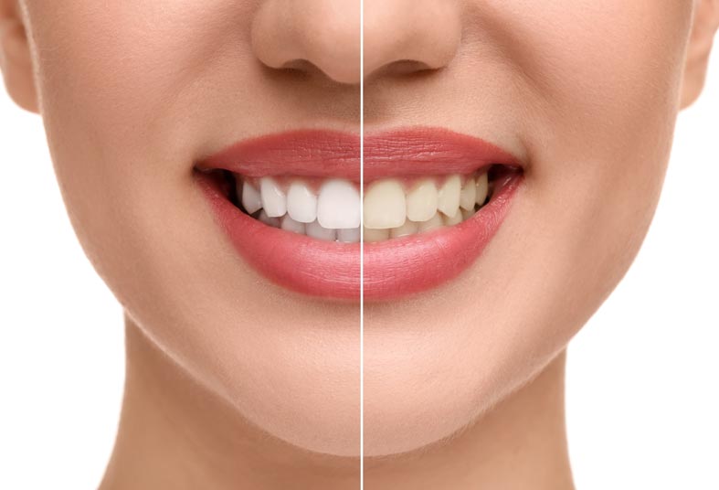 Teeth Whitening