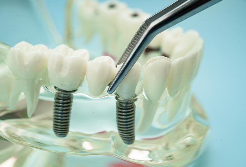 Dental Implants