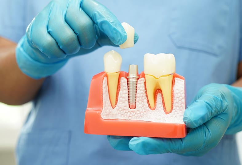 Dental Implants