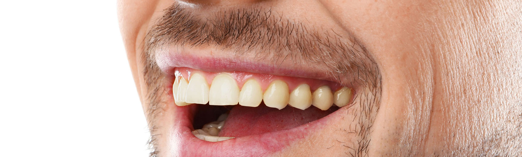 Teeth Whitening Before & After